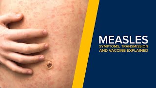 Measles  Symptoms Transmission and Treatment Explained By a Doctor [upl. by Helsa]