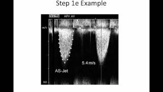 Intro to Aortic Stenosis [upl. by Eipper915]