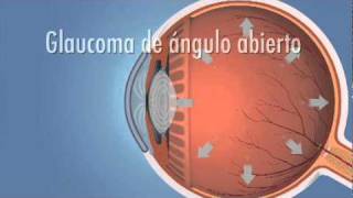 Glaucoma de ángulo Abierto [upl. by Sugihara]