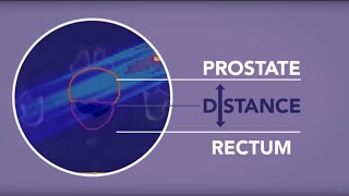 Rectum Spacer in Radiotherapy for Prostate Cancer DGRT [upl. by Nica816]