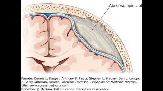 Los Abscesos Epidurales HogarTv por Juan Gonzalo Angel [upl. by Jannel47]