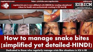 How to manage snake bites HINDI language narration with English slides  RegularCrisis [upl. by Christine59]