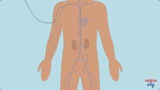 Traitement des varicocèles par embolisation  Chirurgie vasculaire miniinvasive [upl. by Symon]