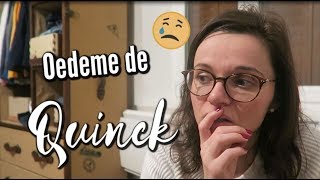 ❥ RÉACTION ALLERGIQUE OEDEME DE QUINCK VLOG FAMILLE 710  ♥ [upl. by Ennaimaj260]