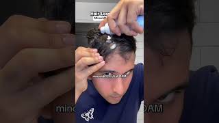 Day250 of Applying Minoxidil Restoring Hairlinebald minoxidil minoxidilresult hairloss [upl. by Aztinay]