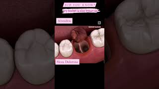 Dry Socket youtubeshorts extraction teeth complication [upl. by Rhodie]