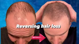 FINASTERIDE  MINOXIDIL IS IT SAFE Reversing hair loss EP 3 pt 2 with CEO Dr Simon Pinstone [upl. by Krongold]