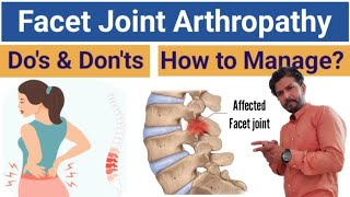 What is Facet Joint Syndrome Full Details  How to Manage Facet Joint Arthropathy [upl. by Enyawed]