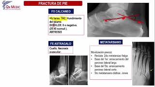 Fracturas Pie  Ortopedia y Traumatología Clases Qx Medic  17 [upl. by Burner]