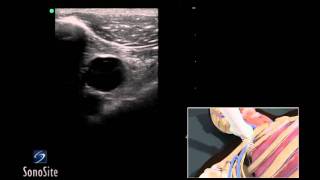 How To Ultrasound Guided Insertion of a Subclavian Vein Catheter 3D Video [upl. by Yreme]