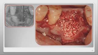 Clinical Case RTR Implant placement after an abscess [upl. by Enivid]