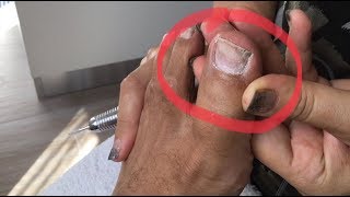 Riparo unghia piede con gel tutorial applicazione gel [upl. by Wadlinger]