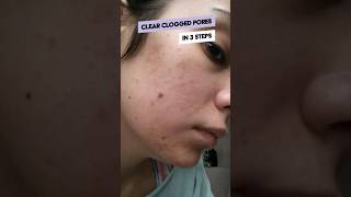 3 steps to clear cloggedpores [upl. by Koehler]