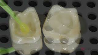 CEMENTACIÓN ZIRCONIA RELYX ULTIMATE [upl. by Stenger]