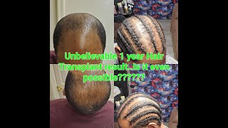 1 Year Hair Journey HairTransplant Istanbul One of The best  Before and After is it Possible [upl. by Tonkin]