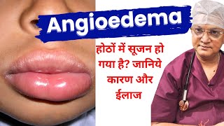 मेरे होंठ सूज गए Angioedema  Swelling of lips and face ANGIOEDEMA Causes Symptoms and Treatment [upl. by Suiradel]