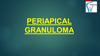 PERIAPICAL GRANULOMA  HINDI [upl. by Halas947]