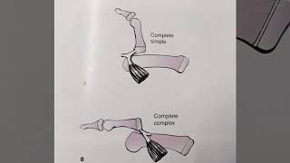 METACARPOPHALANGEAL DISLOCATION THUMB [upl. by Eidnar675]