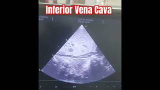 Neonatal Echocardiogram  Showing Inferior Vena Cava IVCvia subcostal view collapsible neonates [upl. by Conard]