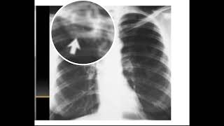 CAVERNA TUBERCULOSA EN RADIOGRAFÍA TELE DE TÓRAX [upl. by Llehsar]