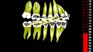 Orthodontie  Thérapeutique DAC  Distal Active Concept [upl. by Arlin]