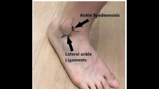 Injuries to the Distal Tibiofibular Syndesmosis [upl. by Cecile]