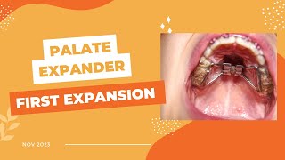 First Expansion of Palate Expander [upl. by Nolek]