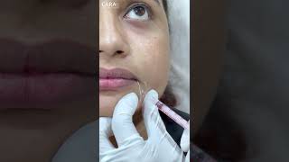 Botox Treatment  Expert Advice and Tips  Cara Clinic [upl. by Salaidh]