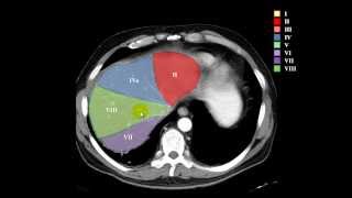 segmentación hepática [upl. by Oinoitna]
