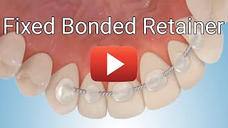 Fixed Bonded Retainer [upl. by Akenor]