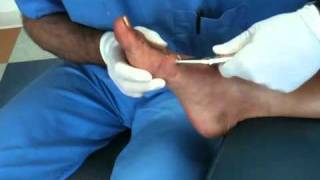 Taking PIN out of Natalies foot after bunion surgery [upl. by Eiramanitsirhc]