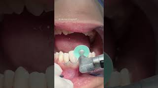 Dental composite veneer satisfying [upl. by Piero160]