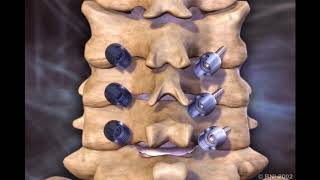 Cervical Lateral Mass Screws [upl. by Goldia840]