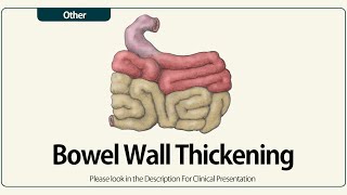 Linear EUS Bowel Wall Thickening [upl. by Nedda]