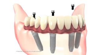 Allon4 procedure animation [upl. by Spooner543]