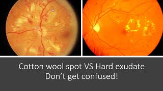 Classification of Diabetic Retinopathy [upl. by Cloots]