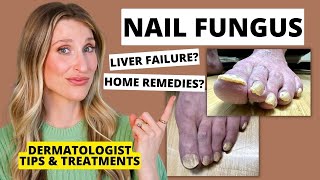 Dermatologist Shares Treatments for Nail Fungus amp Prevention Tips  Dr Sam Ellis [upl. by Ahsenod]