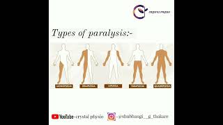 paralysis hemiplegia quadriplegia monoplegia diplegia neurophysiotherapy crystalphysio [upl. by Murray592]