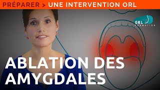 Information Patient  Ablation des amygdales palatines [upl. by Rennob]