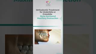 Orthodontic Treatment for Underbite or Crossbite Bone Anchored Maxillary Protraction [upl. by Camel]