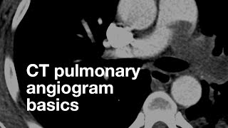 Pulmonary CT Angiogram Basics [upl. by Adnowal]