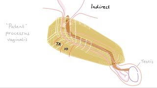 How do we get inguinal hernias [upl. by Ahsiei]