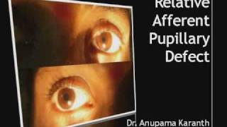 Ophthalmology  Relative Afferent Pupillary Defect RAPD [upl. by Artim463]