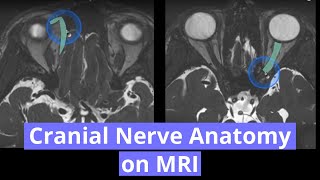 Cranial Nerve Anatomy on MRI [upl. by Cort455]