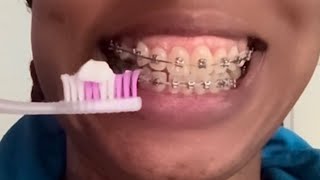 THE TEETH MAINTENANCE WITH BRACES ASMR [upl. by Dnomra]