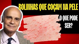 COCEIRA  De onde vem Como aliviar Por Luiz Gameiro dermatologista [upl. by Troth]