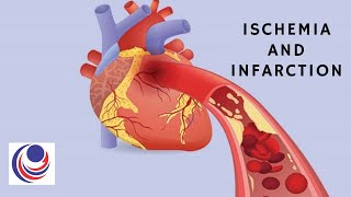 Ischemia and Infarction The difference and Similarities [upl. by Cilurzo695]