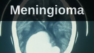 What is a Meningioma Pathology mini tutorial [upl. by Arata]