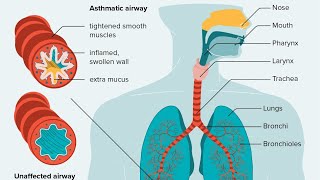 Pathogenesis of Asthma simplified [upl. by Morell208]