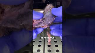 teratome pathologie source extrait video  JAMA [upl. by Jourdan]